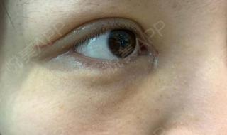 上睑下垂多少钱 上睑下垂多少钱